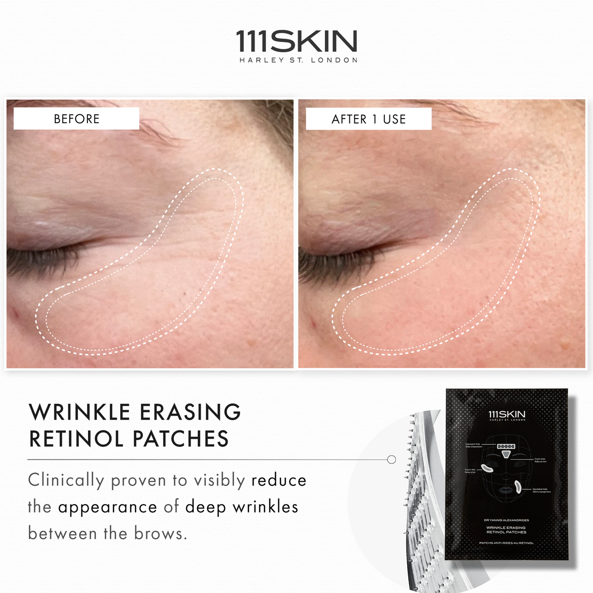 Wrinkle Erasing Retinol Patches