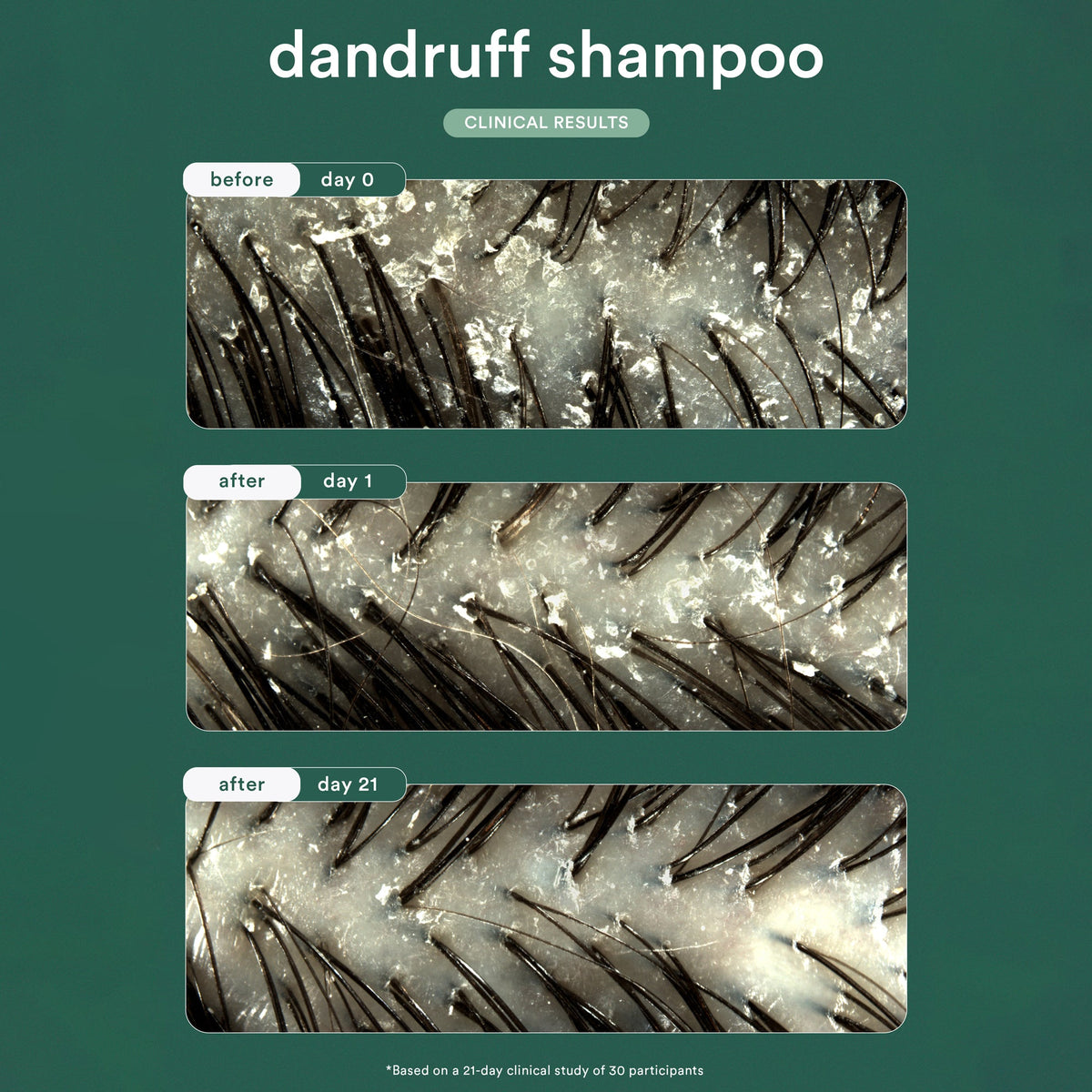 Dandruff Shampoo