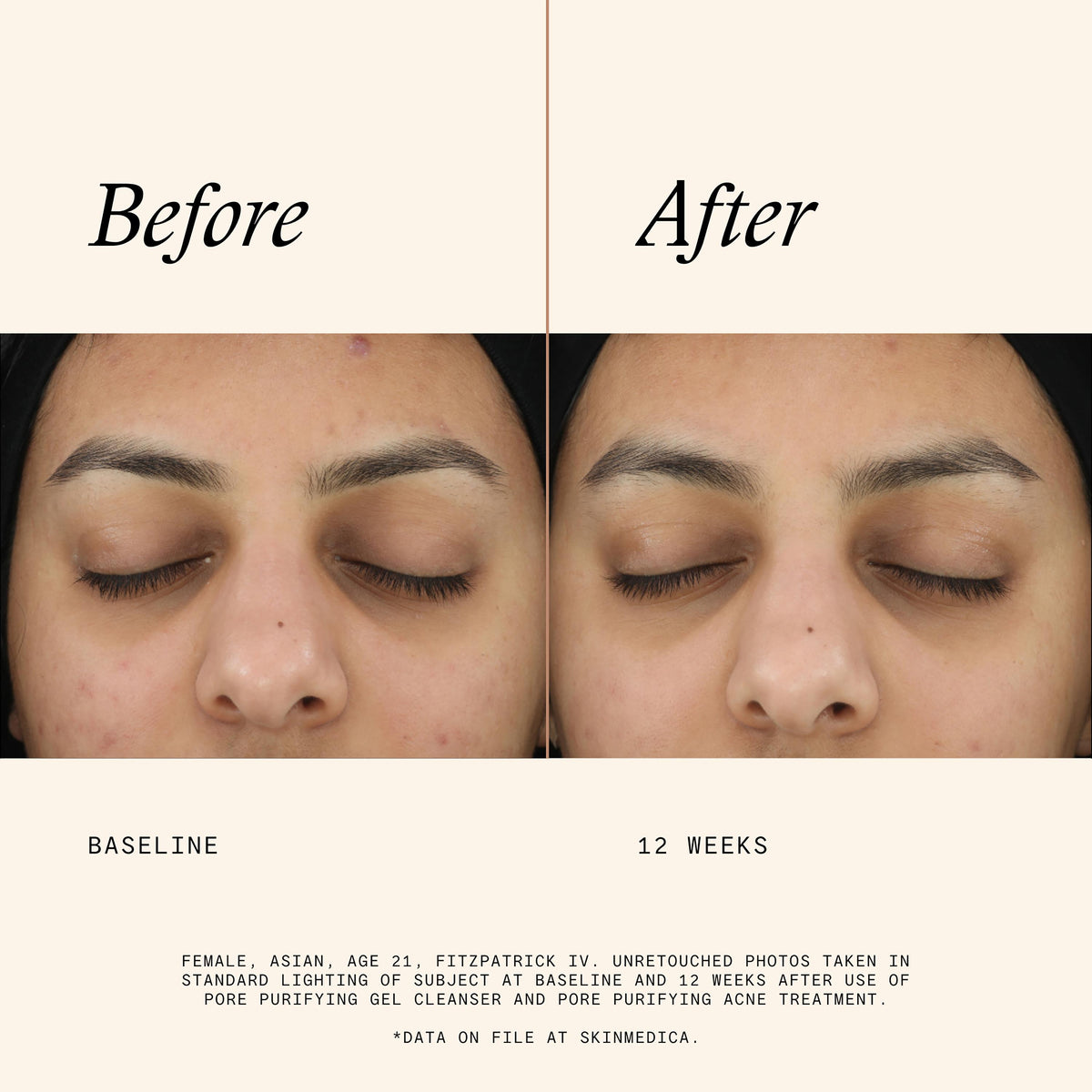 Acne Clarifying Treatment