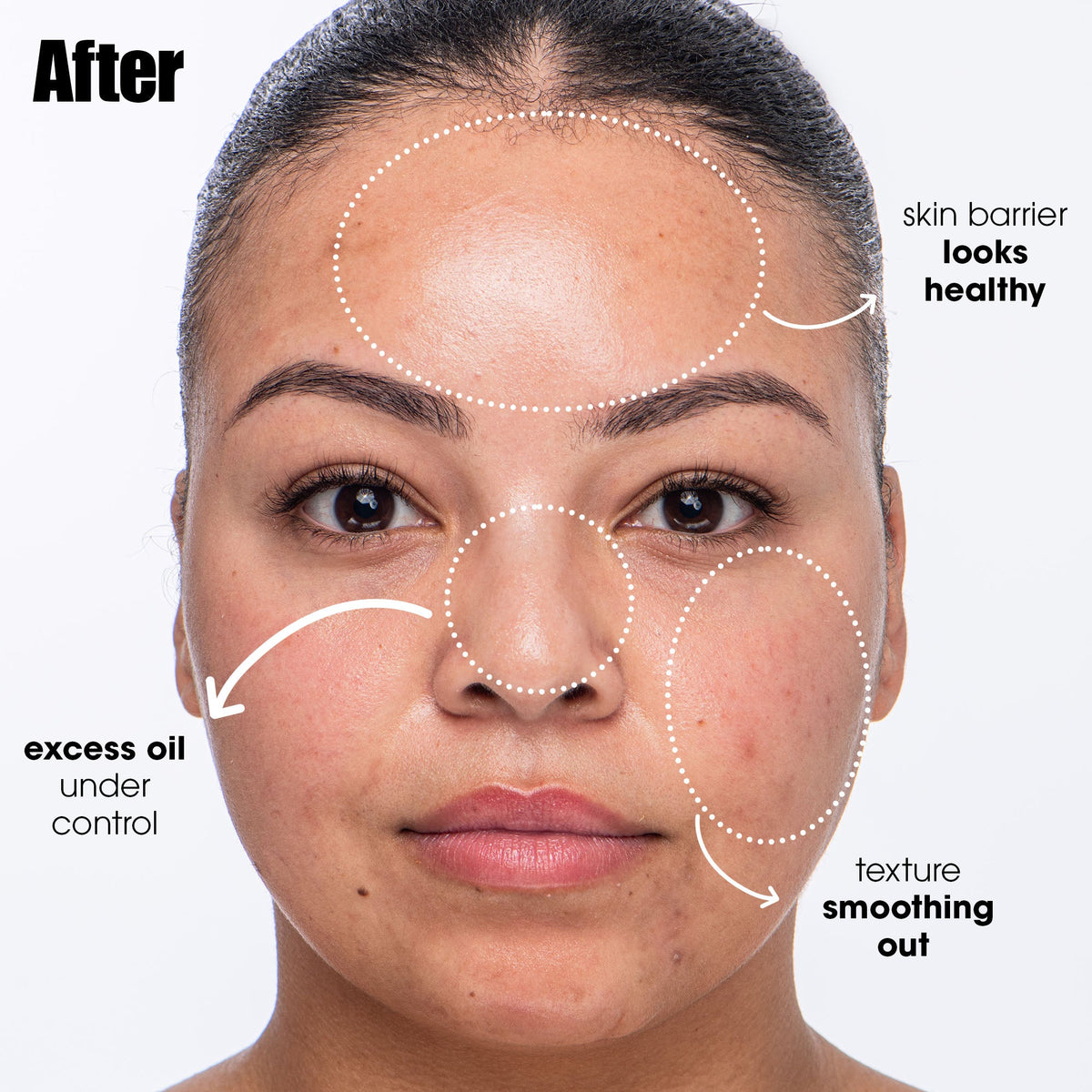 Breakout Breakup Salicylic Acid Cleanser for Blemish-Prone Skin